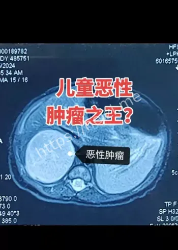 儿童肿瘤分期解读